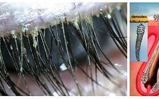 Демодекоз очей симптоми і лікування: як лікувати демодекоз у людини
